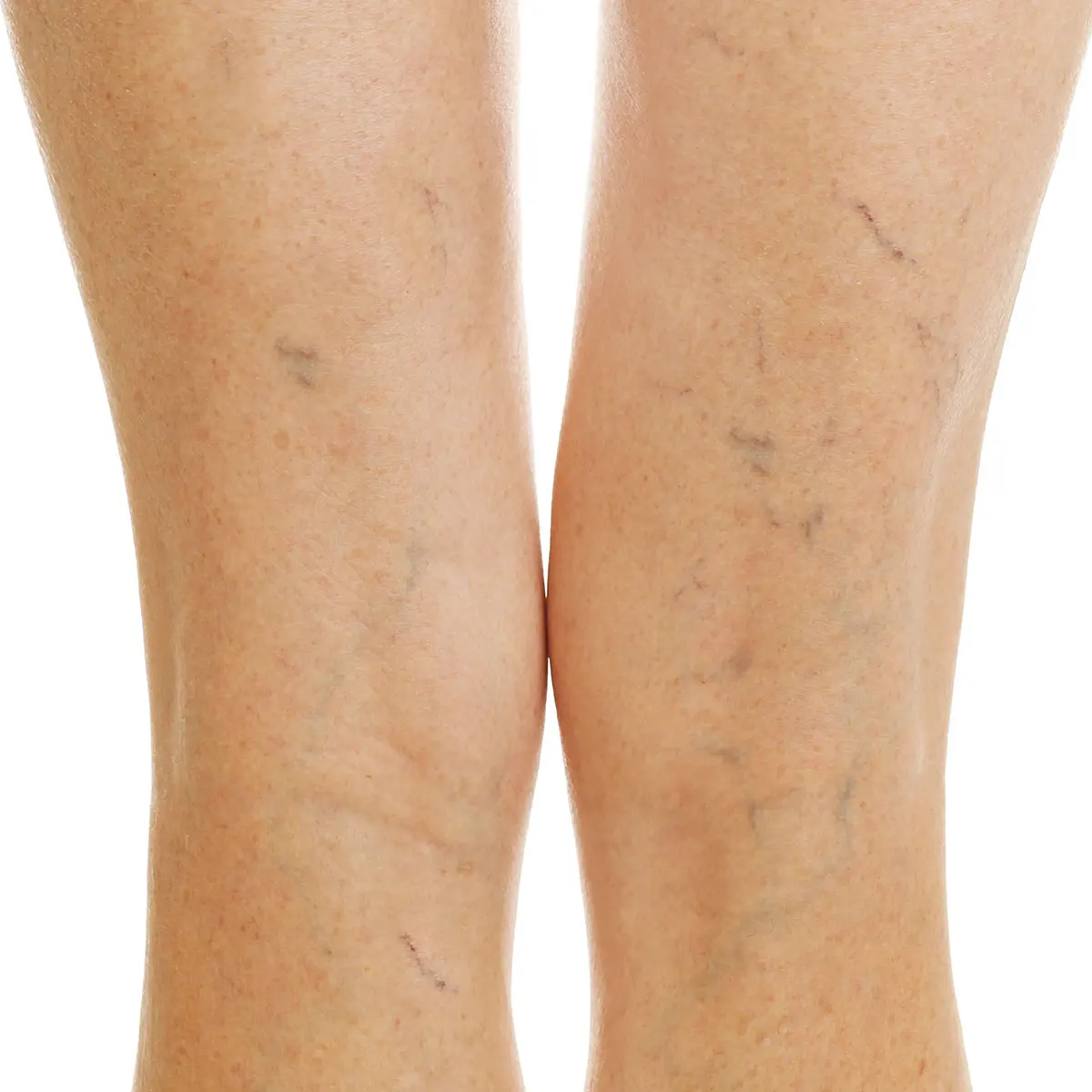 leg-swell-crd-color leg swelling color from venous reflux disease
